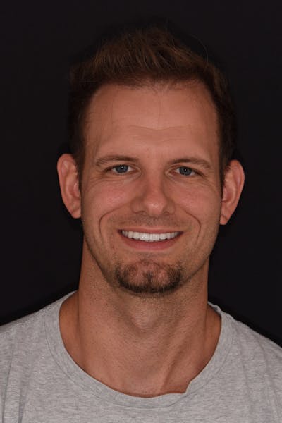 Patient Smile Before & After Gallery - Patient 953671 - Image 1