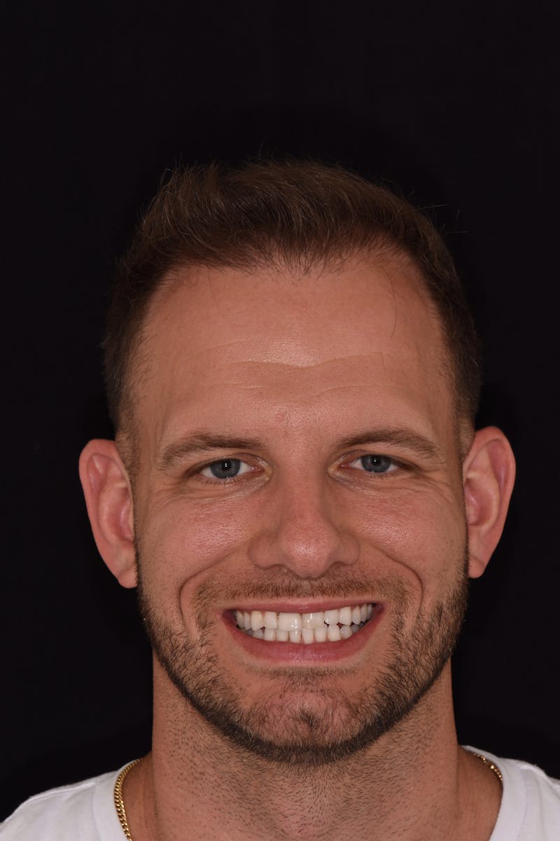 Patient Smile Before & After Gallery - Patient 953671 - Image 2