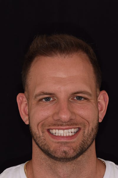Patient Smile Before & After Gallery - Patient 953671 - Image 2