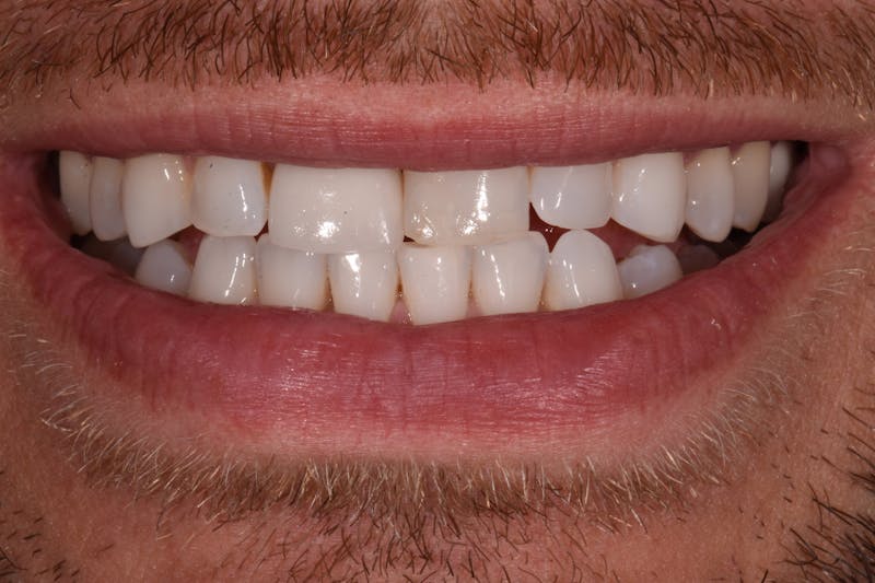 Patient Smile Before & After Gallery - Patient 953671 - Image 3
