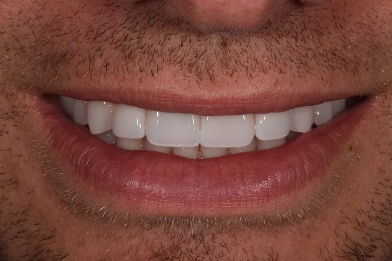 Patient Smile Before & After Gallery - Patient 953671 - Image 4