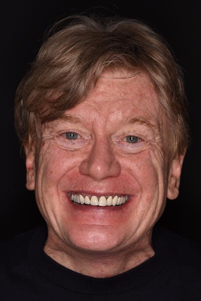 Patient Smile Before & After Gallery - Patient 263651 - Image 1