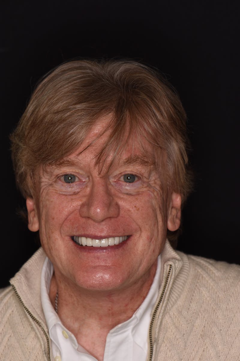 Patient Smile Before & After Gallery - Patient 263651 - Image 2