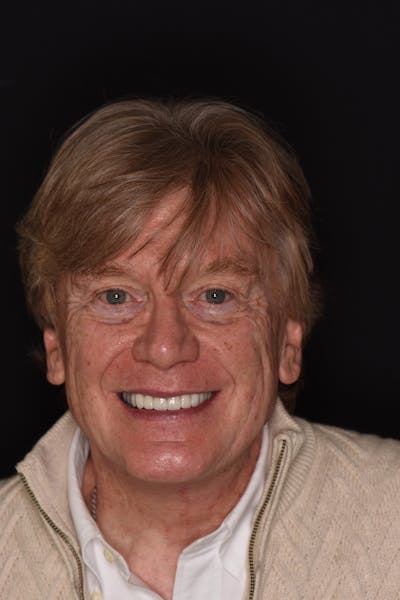 Patient Smile Before & After Gallery - Patient 263651 - Image 2