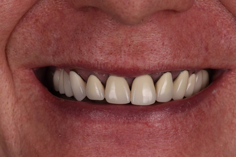 Patient Smile Before & After Gallery - Patient 263651 - Image 3