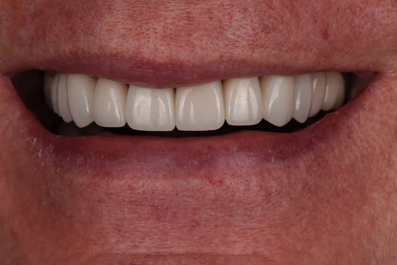 Patient Smile Before & After Gallery - Patient 263651 - Image 4