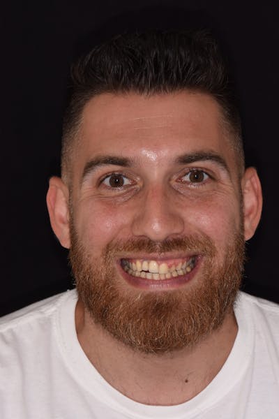 Patient Smile Before & After Gallery - Patient 253132 - Image 1