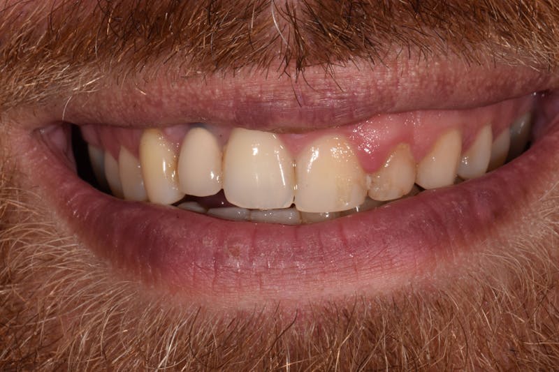 Patient Smile Before & After Gallery - Patient 253132 - Image 3