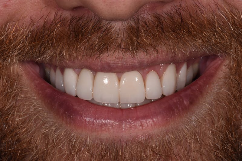 Patient Smile Before & After Gallery - Patient 253132 - Image 4