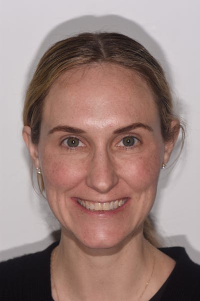 Patient Smile Before & After Gallery - Patient 464726 - Image 1