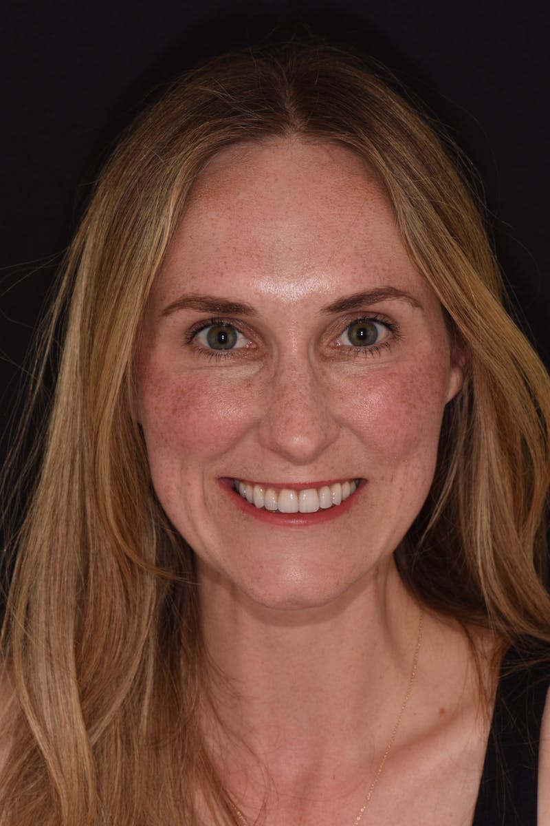 Patient Smile Before & After Gallery - Patient 464726 - Image 2