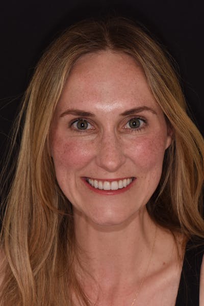 Patient Smile Before & After Gallery - Patient 464726 - Image 2