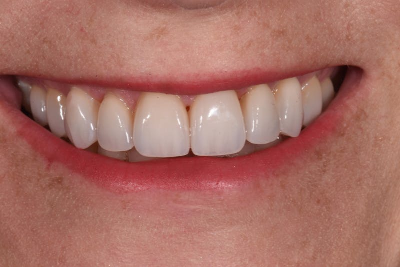 Patient Smile Before & After Gallery - Patient 464726 - Image 4