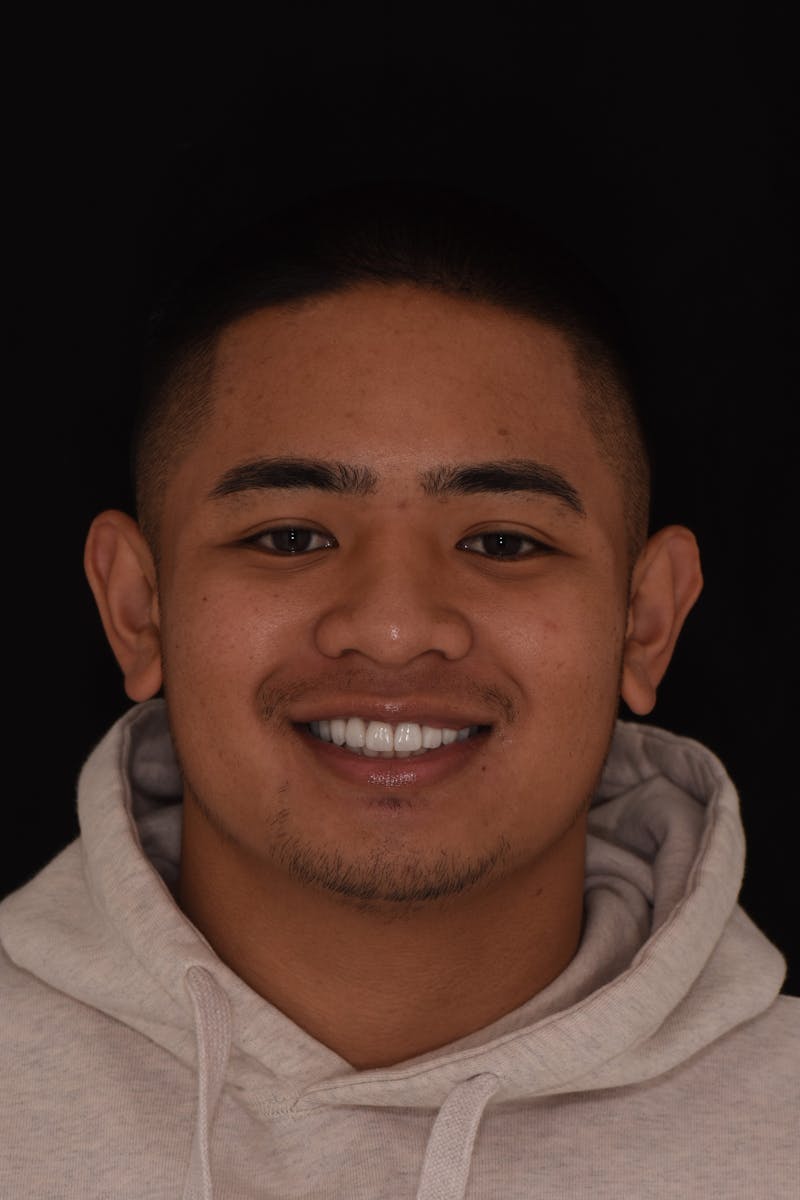 Patient Smile Before & After Gallery - Patient 286697 - Image 2