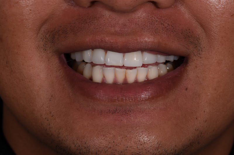 Patient Smile Before & After Gallery - Patient 286697 - Image 3