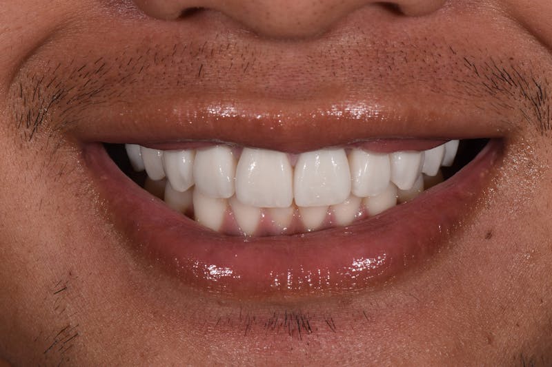 Patient Smile Before & After Gallery - Patient 286697 - Image 4