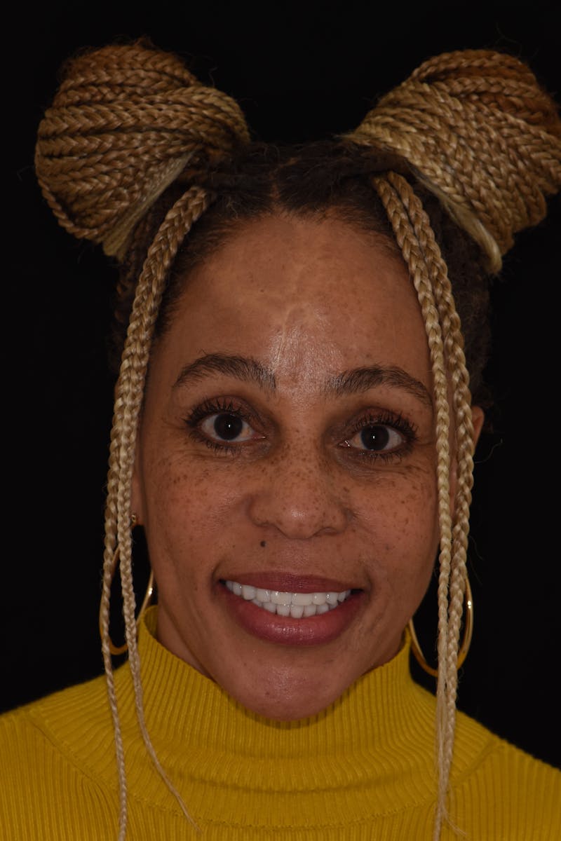 Patient Smile Before & After Gallery - Patient 462821 - Image 2