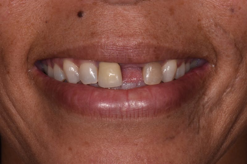 Patient Smile Before & After Gallery - Patient 462821 - Image 3