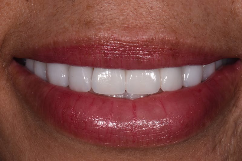 Patient Smile Before & After Gallery - Patient 462821 - Image 4