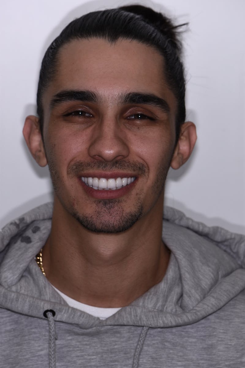 Patient Smile Before & After Gallery - Patient 184701 - Image 2