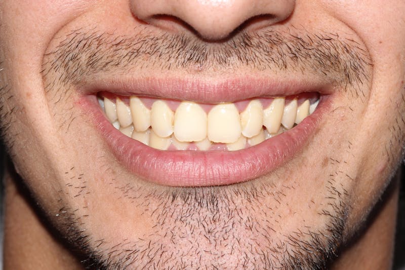 Patient Smile Before & After Gallery - Patient 184701 - Image 3