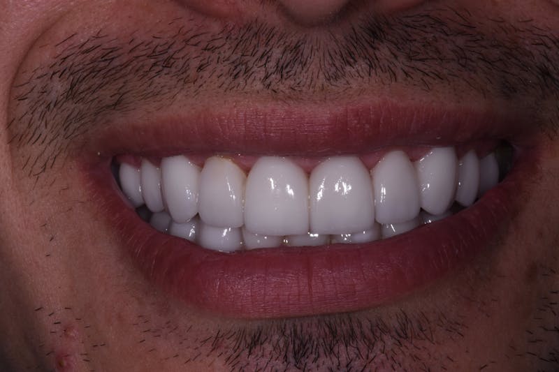 Patient Smile Before & After Gallery - Patient 184701 - Image 4