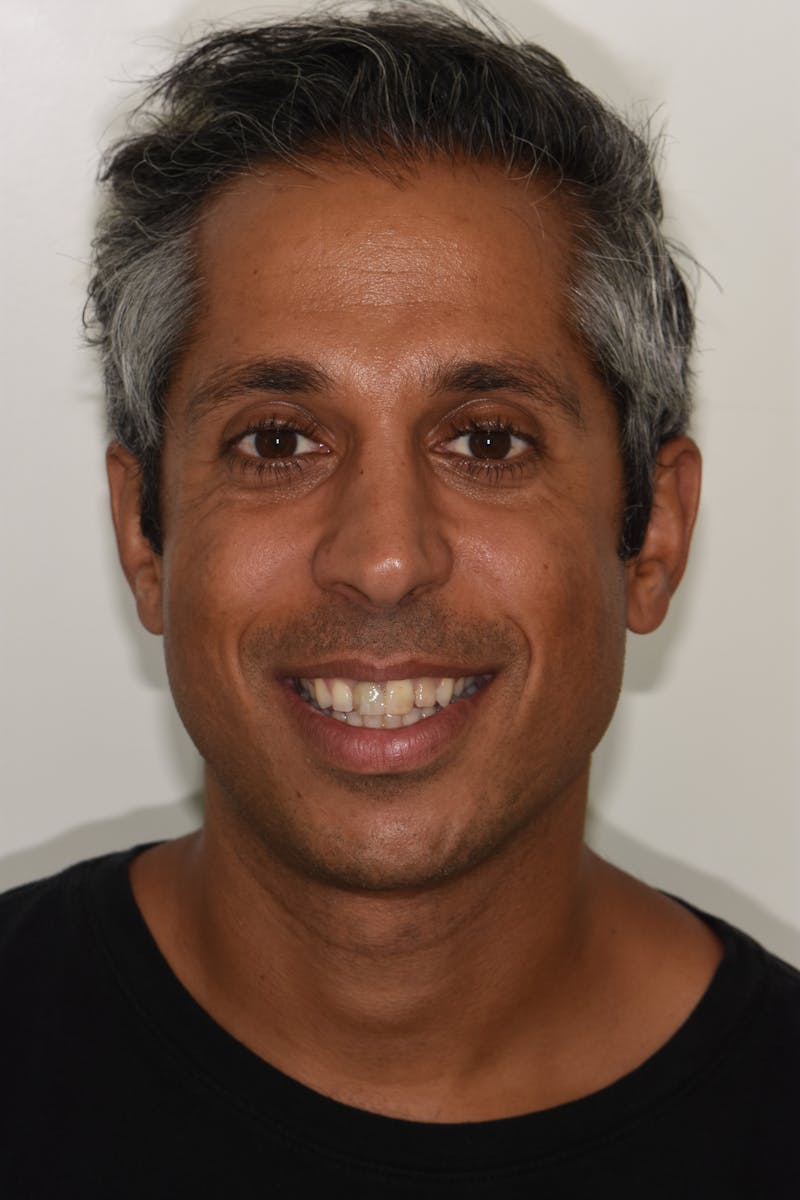 Patient Smile Before & After Gallery - Patient 200704 - Image 1