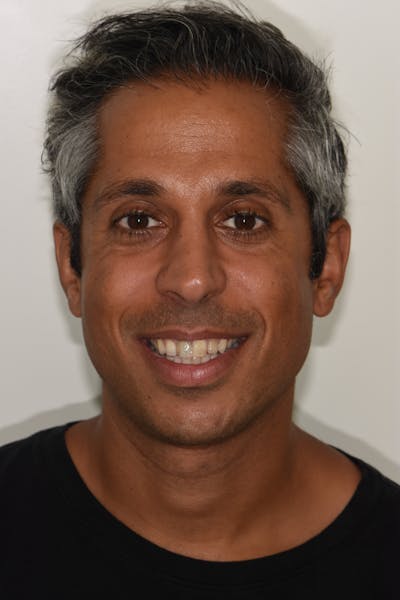 Patient Smile Before & After Gallery - Patient 200704 - Image 1