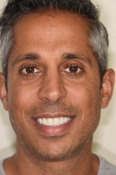 Patient Smile Before & After Gallery - Patient 200704 - Image 2