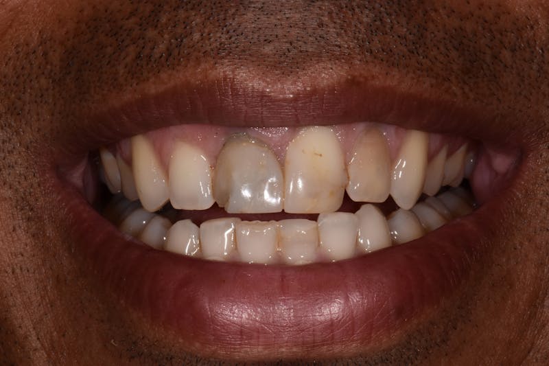 Patient Smile Before & After Gallery - Patient 200704 - Image 3