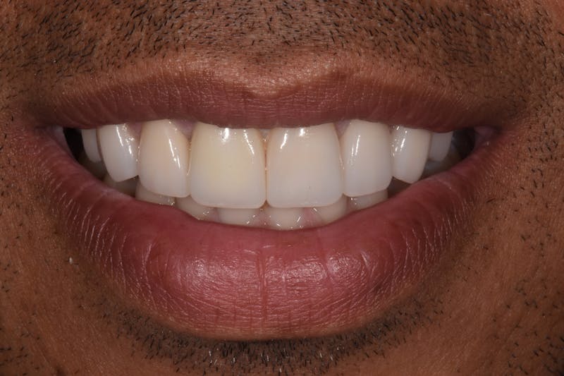 Patient Smile Before & After Gallery - Patient 200704 - Image 4