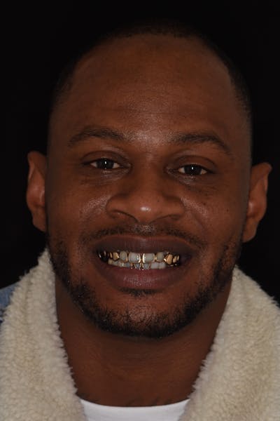 Patient Smile Before & After Gallery - Patient 285102 - Image 1