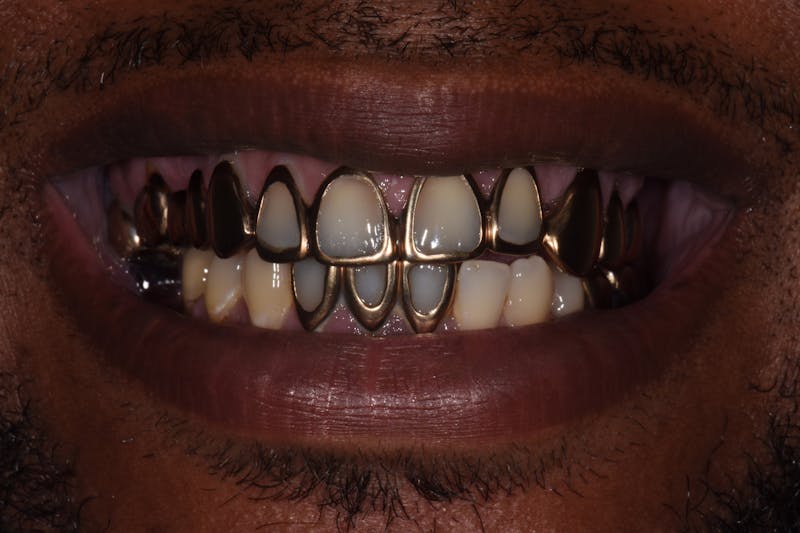 Patient Smile Before & After Gallery - Patient 285102 - Image 3