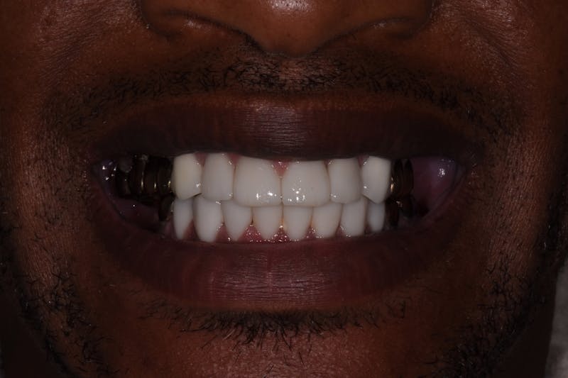 Patient Smile Before & After Gallery - Patient 285102 - Image 4
