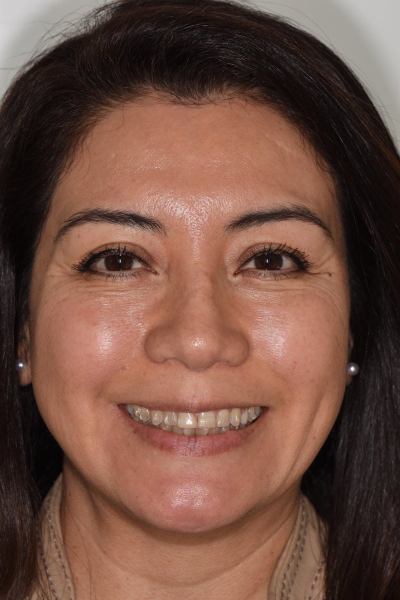 Patient Smile Before & After Gallery - Patient 114462 - Image 1