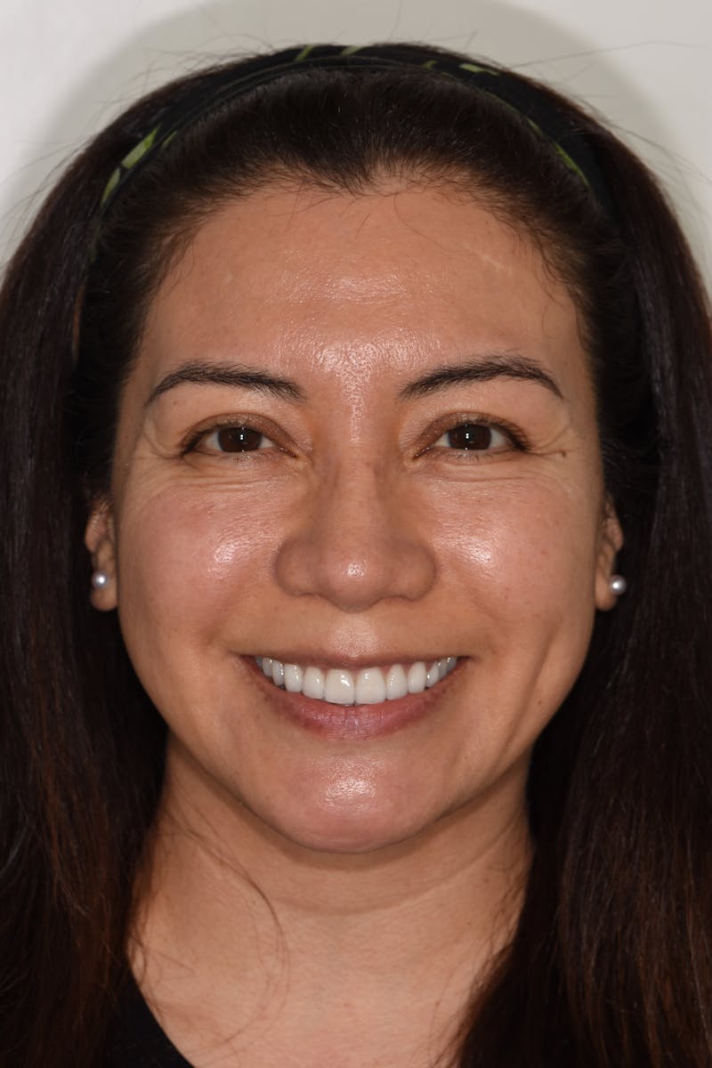 Patient Smile Before & After Gallery - Patient 114462 - Image 2