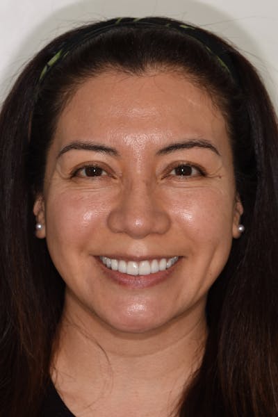 Patient Smile Before & After Gallery - Patient 114462 - Image 2