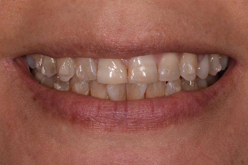 Patient Smile Before & After Gallery - Patient 114462 - Image 3