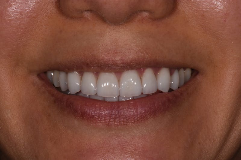 Patient Smile Before & After Gallery - Patient 114462 - Image 4