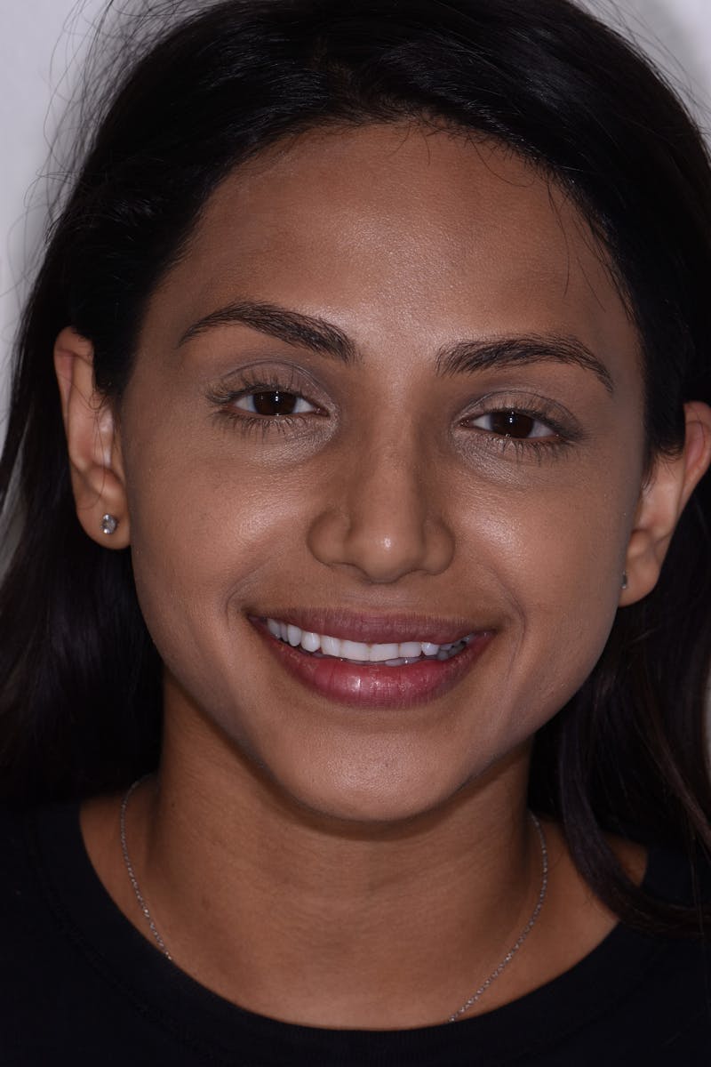 Patient Smile Before & After Gallery - Patient 168208 - Image 1