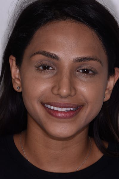 Patient Smile Before & After Gallery - Patient 168208 - Image 1