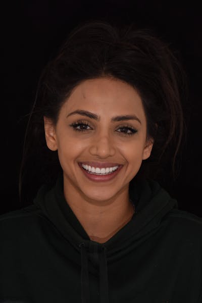 Patient Smile Before & After Gallery - Patient 168208 - Image 2