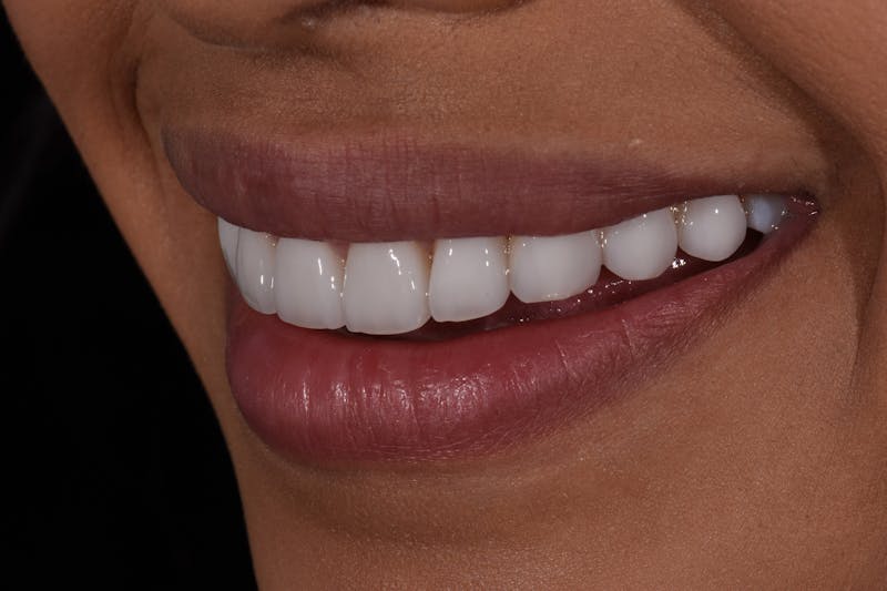 Patient Smile Before & After Gallery - Patient 168208 - Image 4