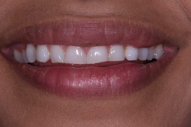 Patient Smile Before & After Gallery - Patient 168208 - Image 5