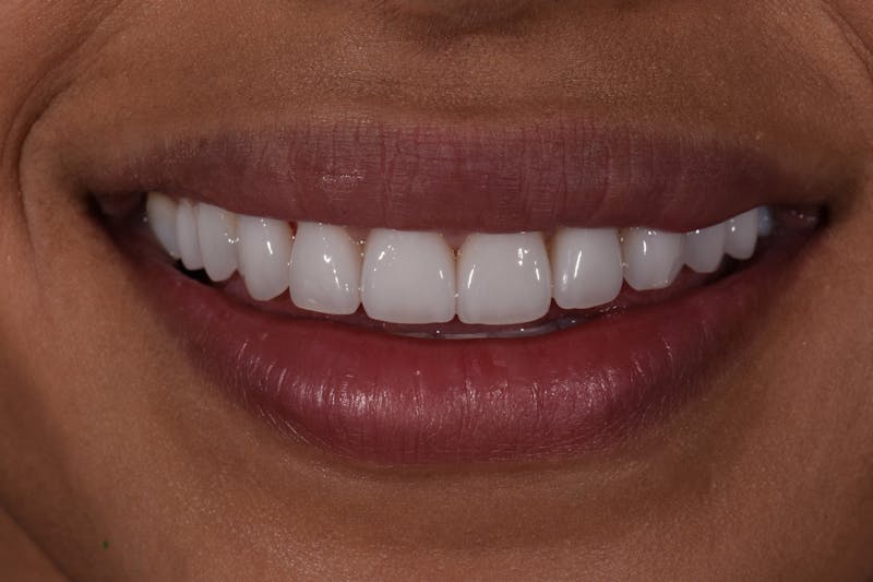 Patient Smile Before & After Gallery - Patient 168208 - Image 6