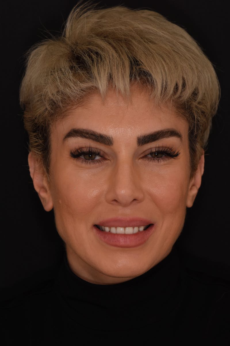 Patient Smile Before & After Gallery - Patient 340304 - Image 1