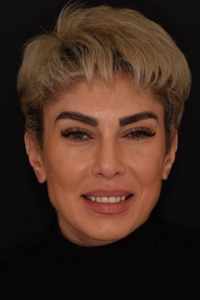 Patient Smile Before & After Gallery - Patient 340304 - Image 1