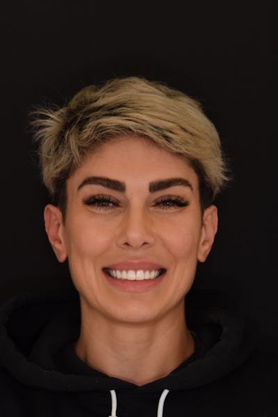 Patient Smile Before & After Gallery - Patient 340304 - Image 2