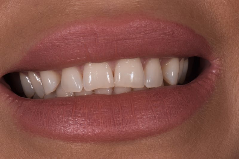 Patient Smile Before & After Gallery - Patient 340304 - Image 3