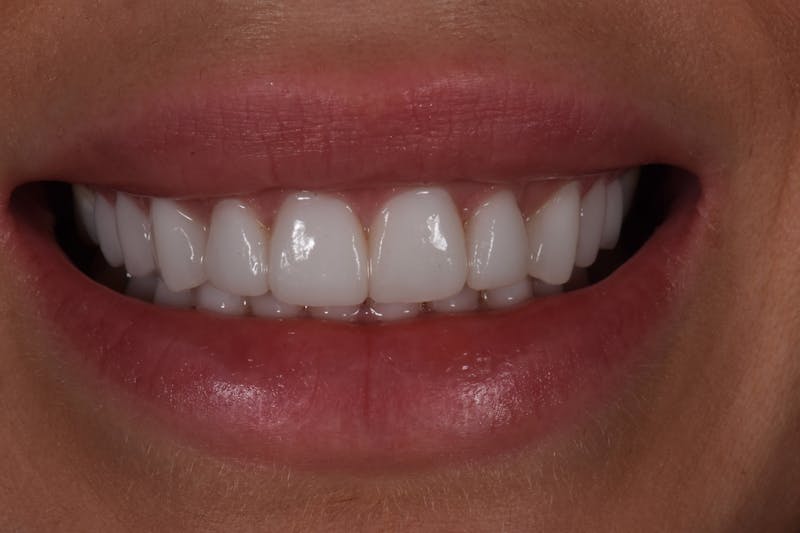 Patient Smile Before & After Gallery - Patient 340304 - Image 4